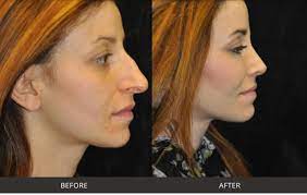 Boston’s Leading Clinics for Jawline Enhancement